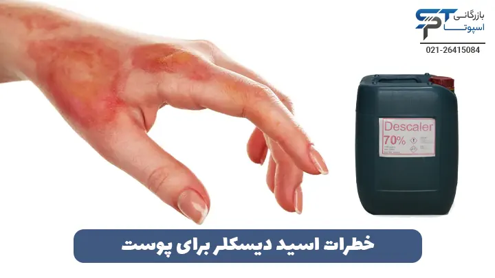 خطرات اسید دیسکلر 8 خطرات اسید دیسکلر برای پوست