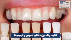 سفید کردن دندان با هیدروژن پراکسید 6 تفاوت رنگ بین دندان طبیعی و ترمیم ها - بازرگانی اسپوتا