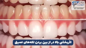 سفید کردن دندان با هیدروژن پراکسید 2 اثربخشی بالای هیدروژن پراکسید در از بین بردن لکه های عمیق دندان - بازرگانی اسپوتا