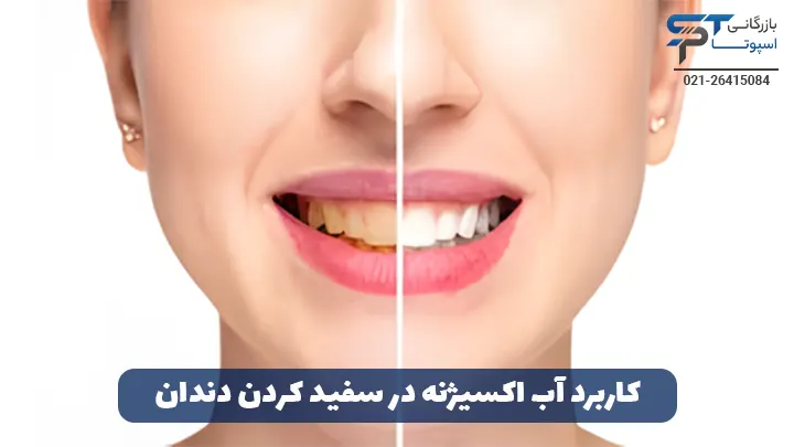 کاربرد هیدروژن پراکسید ( آب اکسيژنه) در سفید کردن دندان - بازرگانی اسپوتا